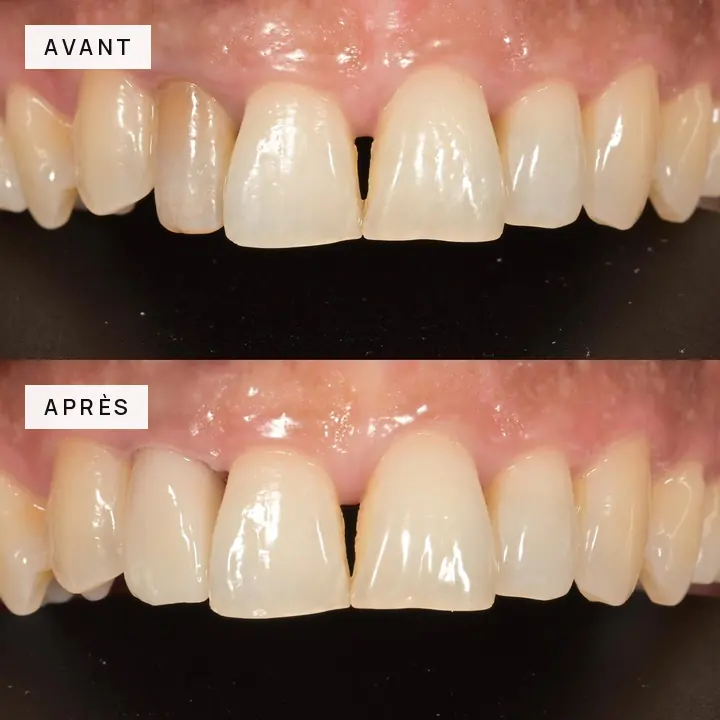 cas-clinique-01-incisives-centrales-avant-apres