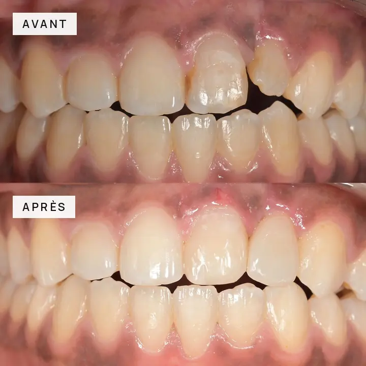 cas-clinique-02-incisive-fracturee-avant-apres