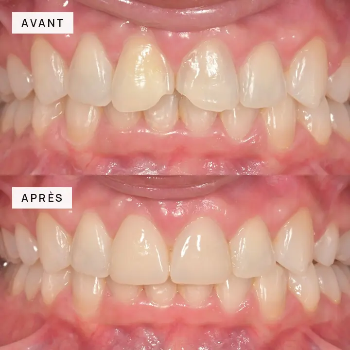 cas-clinique-03-incisives-centrales-avant-apres