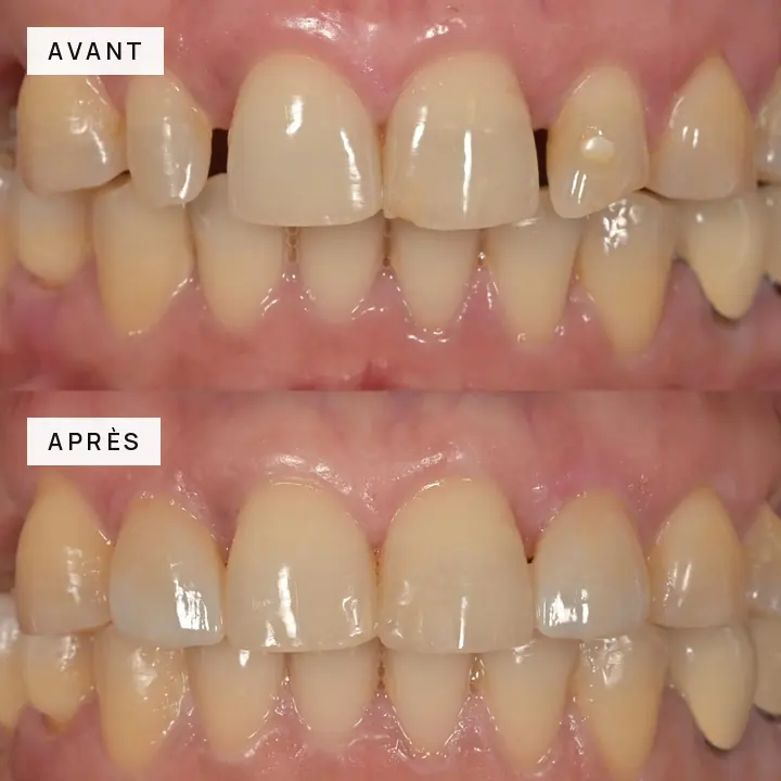 cas-clinique-04-dents-anterieures-avant-apres
