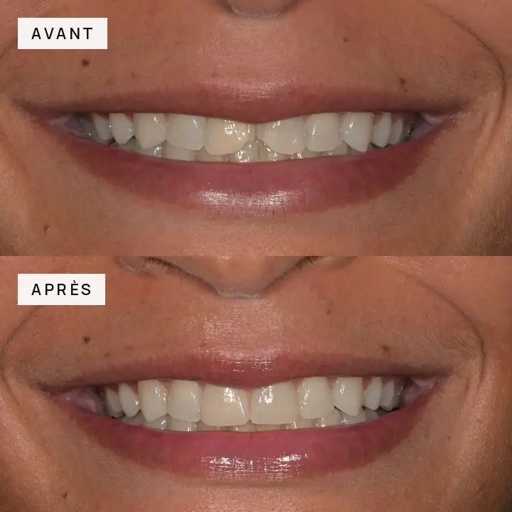 cas-clinique-05-sourire-avant-apres