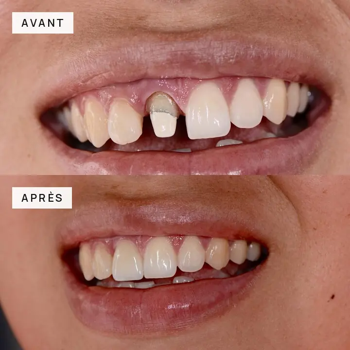 cas-clinique-06-couronne-incisive-avant-apres