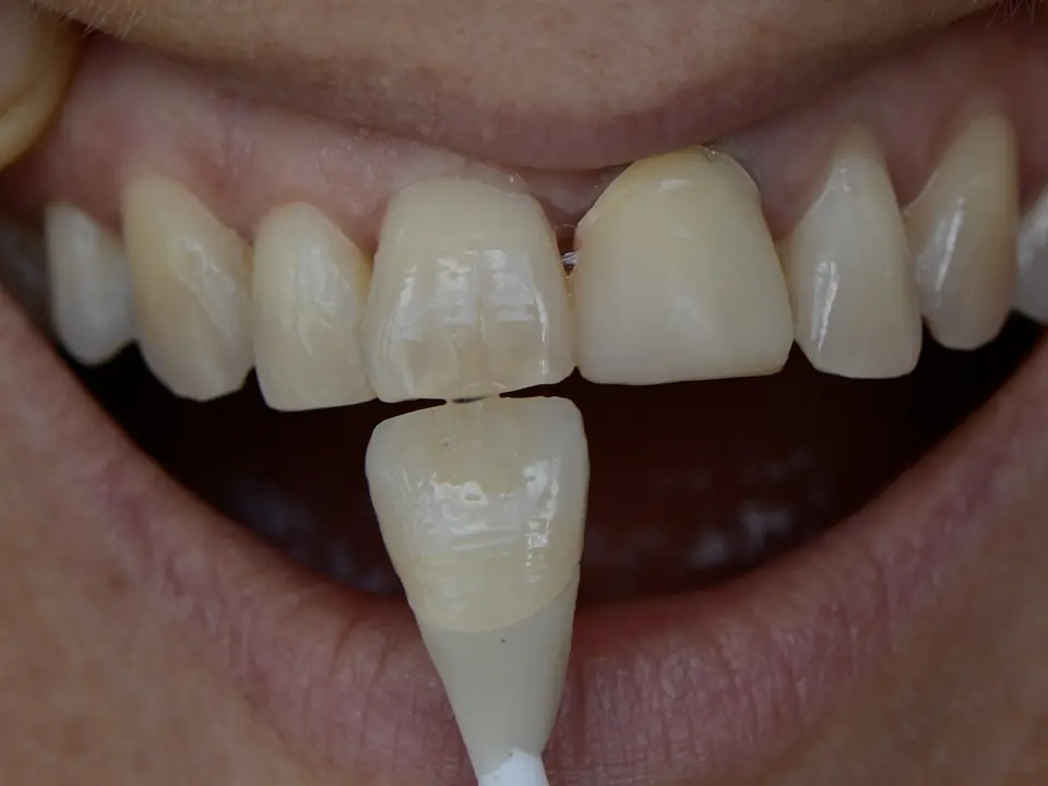 controle-de-teinte-devant-les-dents-du-patient