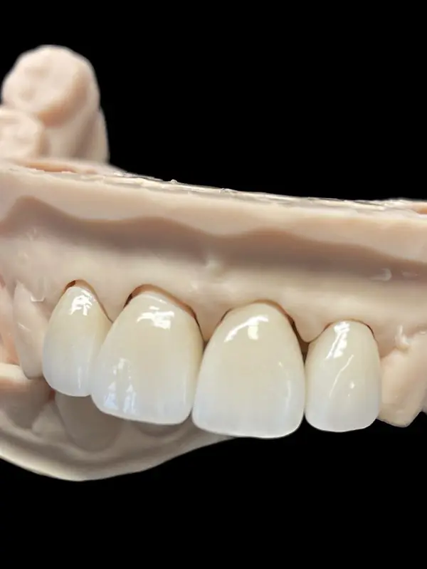 couronnes-anterieures-sur-modele-laboratoire-dentaire