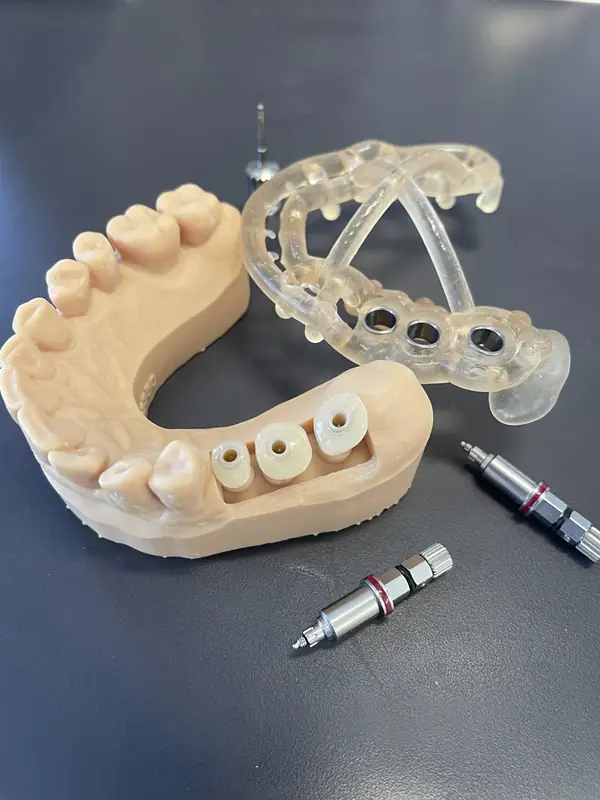 modele-analogues-implants-guide-chirurgical